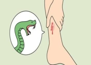 सांप के काटने पर झाड़-फूंक नहीं, डॉक्टर के पास जाएं – रांची में बढ़े सर्पदंश के मामले